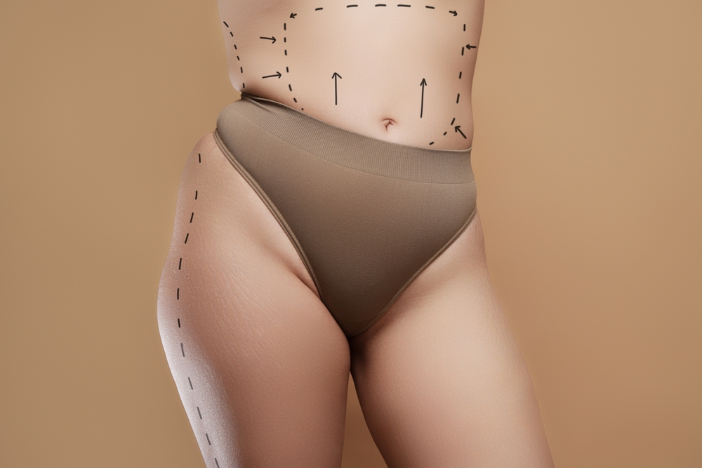 Liposuction