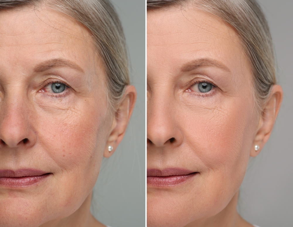 Facelift